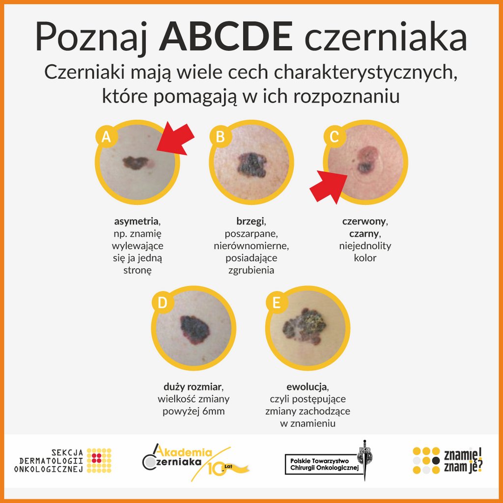 ABC czerniaka